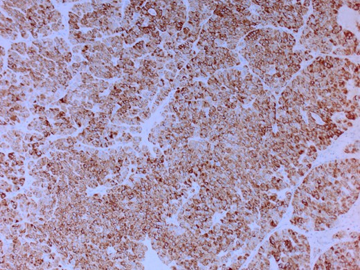 Positive for immune staining CK7.