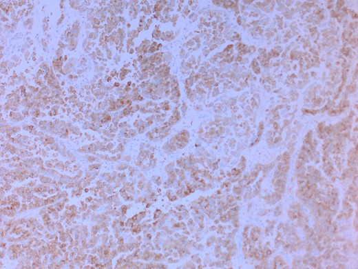 Positive immune staining for synaptophysin.