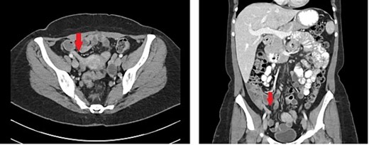 Representative axial and coronal cuts of CT imaging showing an 8 mm dilated appendix noted by the arrow.