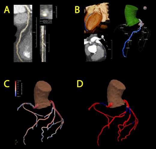 Semi-automated segmentation of the coronary artery tree, followed by manual refinement of each segmented artery (A) and transformation into a 3D representation (B). Subsequently, incorporation into an overall coronary artery structure follows through two models: the gradual flow model (C) and the stenosis detection model (D). Optimal blood flow is represented in red, while diminished blood flow is denoted by the color blue.