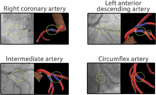 Coronary angiogram results of the patient aligned with the 3D coronary artery model on the CoronaryXR platform. Yellow circles highlight a total occlusion in the right coronary artery and significant stenosis in the left anterior descending, intermediate and circumflex arteries.