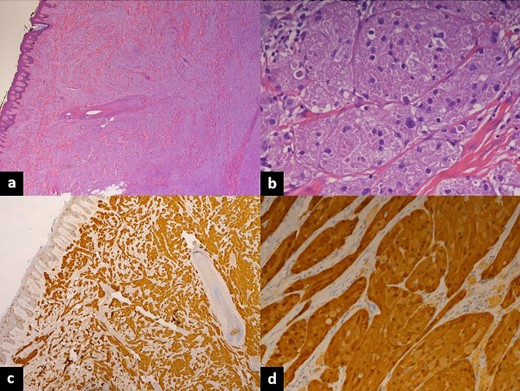 Histopathology of excised lesions. (a) Low-magnification hematoxylin and eosin stain showing ill-defined proliferation of large bland cells with mild epithelial hyperplasia. (b) High-magnification hematoxylin and eosin stain showing ill-defined proliferation of large bland cells with prominent eosinophilic granular cytoplasm. (c) Low magnification showing neoplastic cells strongly positive for S100 and negative for desmin; Ki-67 shows 2–3% of the cells to be positive. (d) High magnification showing neoplastic cells strongly positive for S100 and negative for desmin, Ki-67 shows 2–3% of the cells to be positive.