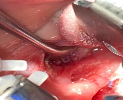 Left tonsil with clear intraoral fistula opening colored by methylene blue with fibrin before removal.