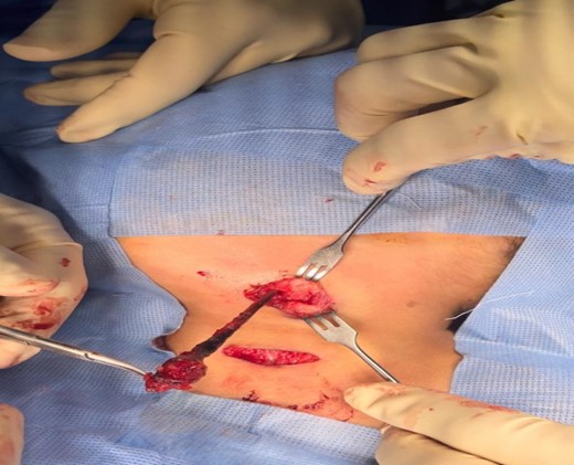 The branchial firm colored tract seen clearly after delivery it by upper step ladder incision. Notice the tract removed without excessive tissue removal around it.