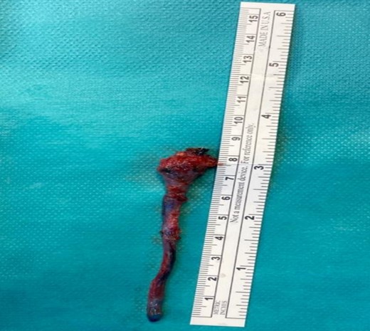 The complete neck tract after excision.