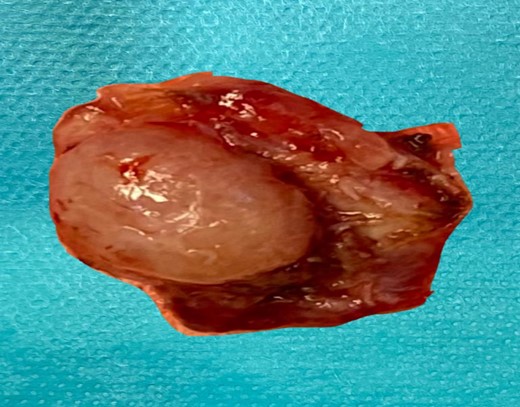 The left tonsill after removal and tract opening seen clearly on its surface.