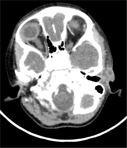 This is the axial cut CT that showed left-sided cystic lesion representing infected preauricular sinus. The CT did not show the second branchial cyst or tract that was found in clinical examination.