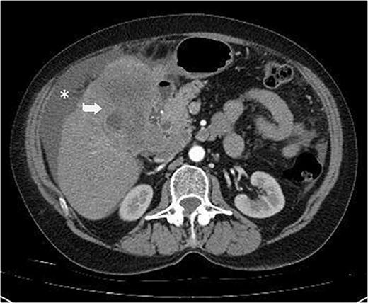 Irregular liver contours and perihepatic free fluid (*). Dense heterogeneous mass at the level of liver segment 4B-5, ~10×10 cm in area and extending to segment 6 (Arrow). Borders of the gallbladder could not be seen.