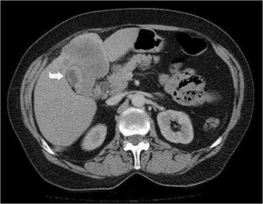 Hypodense lesions in the left lobe of the liver, 10×8 cm in size, protruding into the inferior perihepatic space and 3.5 cm in diameter in the right lobe segment 5 with no significant contrast enhancement after intravenous contrast material injection (Arrow).