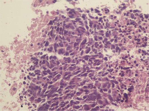 Monotonous tumor cells in a necrotic background (40×).