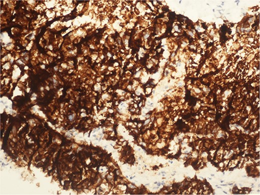 CD 56 positive immunohistochemical examination (20×).