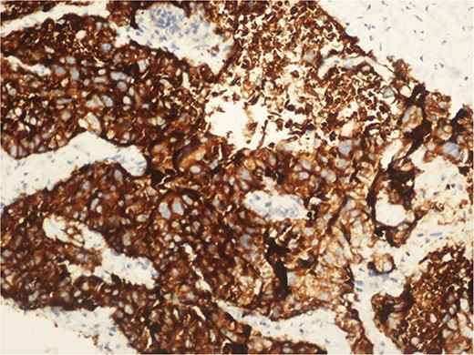Synaptophysin positive immunohistochemical examination (20×).