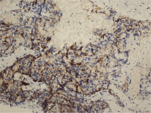 Chromogranin A positive immunohistochemical examination (20×).