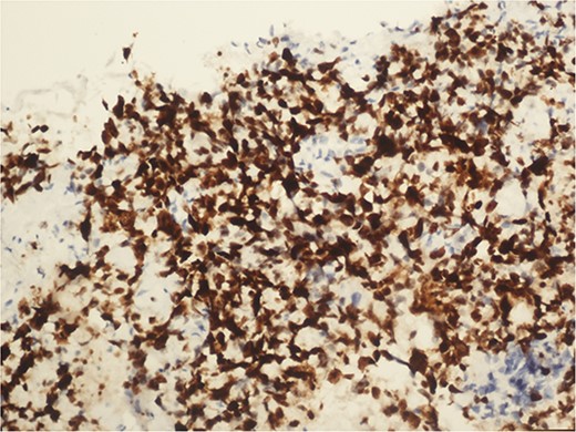 Immunohistochemical examination of Ki 67 index 90% (20×).