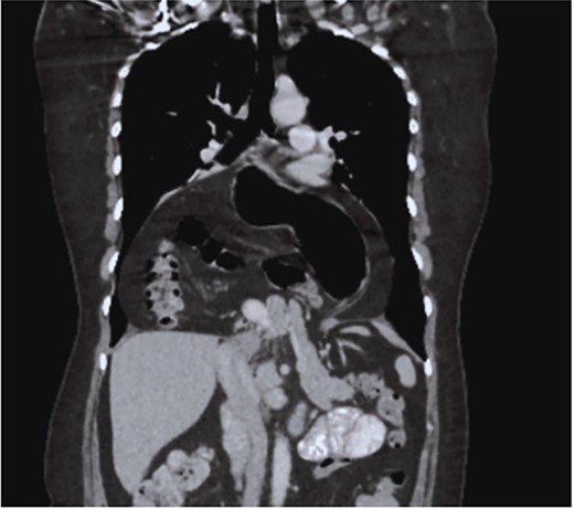 CT coronal section, showing the presence of the stomach, duodenum, small intestine, colon, and pancreas.