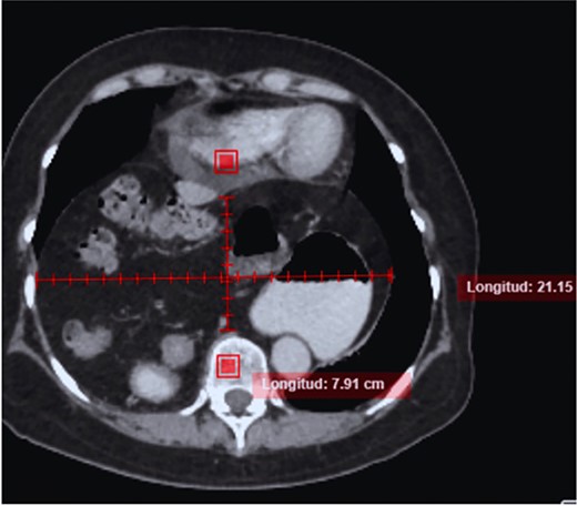 CT in axial section, hernia sac measuring ~21 × 15 × 7 cm is observed.
