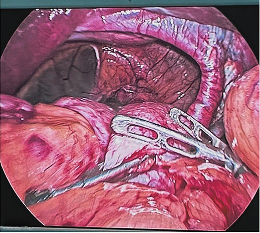 Reduction of the contents of the hernial sac with intestinal forceps and blunt dissection. Hiatal defect of ~12 cm.