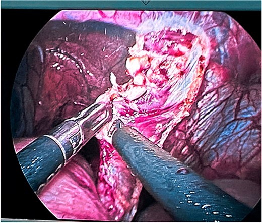 Dissection and resection of hernial sac with traction and monopolar energy.