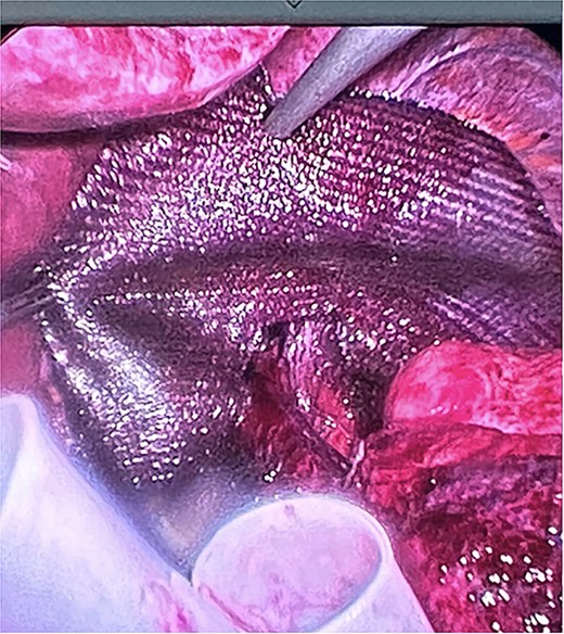 Placement of composite mesh with resorbable coating and fixing it with automatic titanium spiral sutures reducing the esophageal hiatus up to 3 cm.