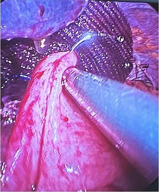 Modeling of Toupet fundoplication with intracorporeal technique with polypropylene suture 2-0.