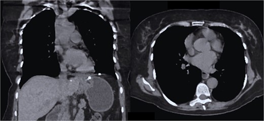 CT coronal and axial sections, showing complete re-expansion of both lung fields and the fixed mesh at the level of the hiatus esophageal without evidence of a hernia sac or recurrence.