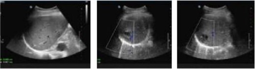 Abdominal color ultrasound findings on the third day after surgery.