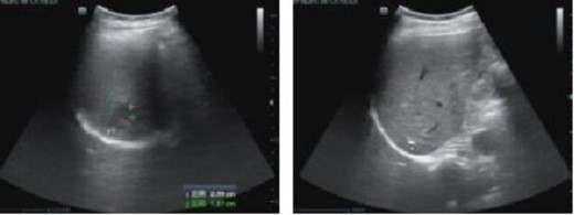 Abdominal color ultrasound findings on the 12th day after surgery.