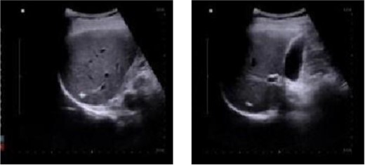 Abdominal color ultrasound findings on the 30th day after surgery.