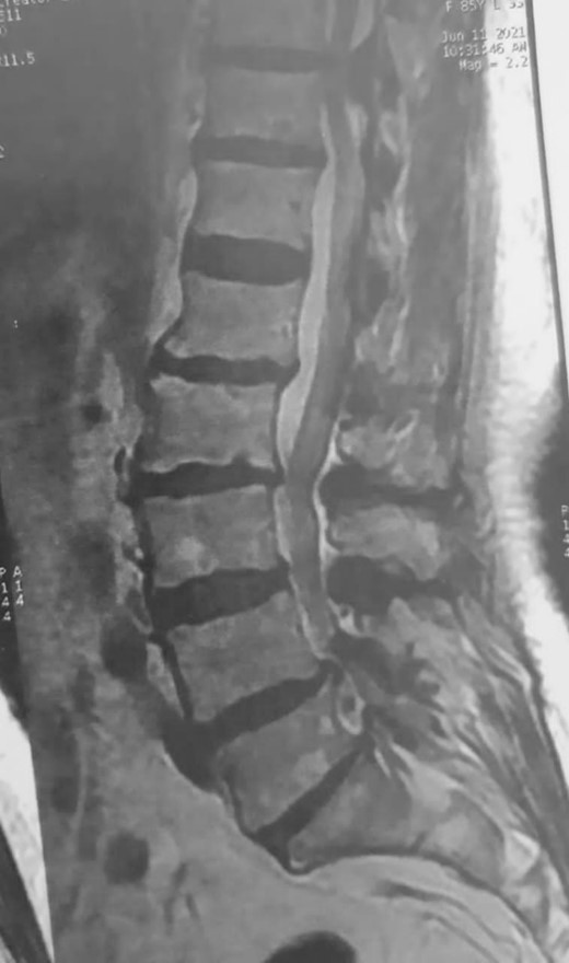 Preoperative MRI, sagittal view, T2WI, shows tumor mass at levels D10–D11.