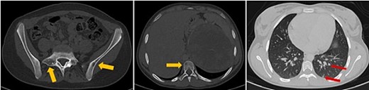 Axial thoraco-abdominal CT image on the bone window showing lytic bone lesions of the left iliac wing, sacrum, and vertebral bodies and on the pulmonary window showing pulmonary nodules.