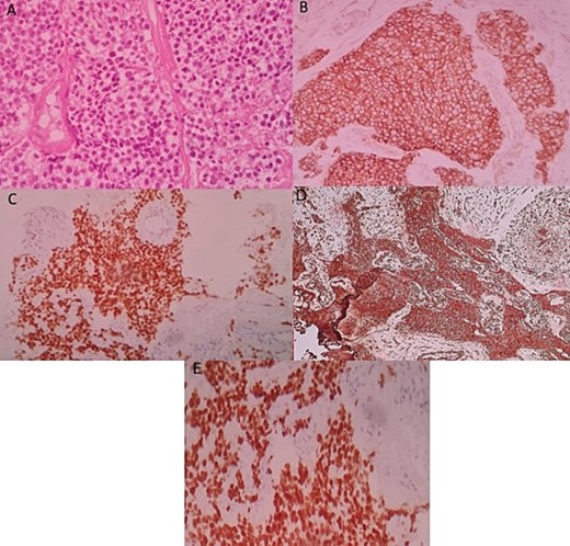 Histologic and immunohistochemical staining photomicrographs show sheets of small blue cells, scant cytoplasm with round or oval nuclei (A; H-E stain; original magnification, ×400), membranous expression of CD99 (B; CD99; original magnification, ×200), nuclear expression of NKX2-2 (C; original magnification, ×200), cytoplasmic expression of vimentine (D; original magnification, ×200), and nuclear expression of FLI1 (E; original magnification ×200), findings that are characteristic for EWS.