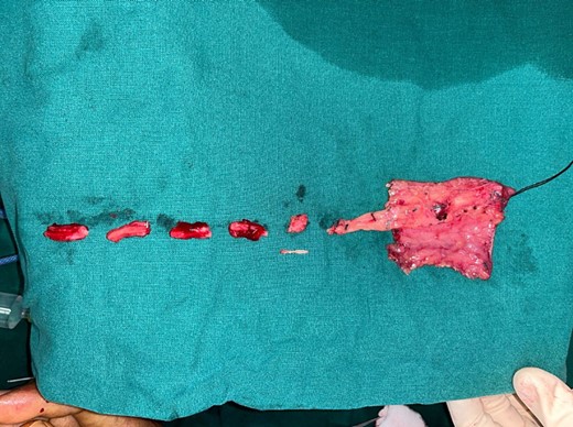 Sequential cutback of the radial artery, showing hard fibrous plaque starting from around 10 cm proximal to the skin paddle.