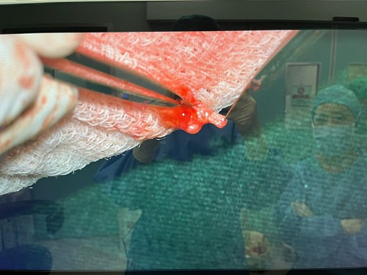 Microscopic view of fibrous plaque within the lumen of the radial artery.