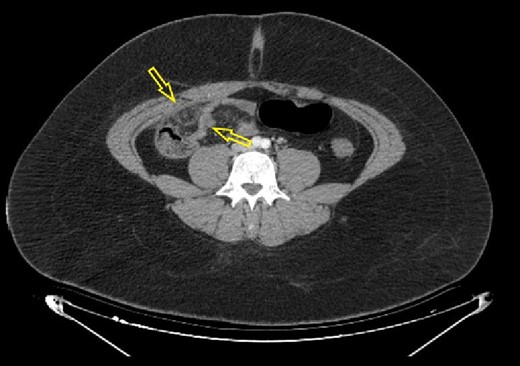 Axial abdominal CT scan (native series) showing intra-abdominal fat inflammation in the pericecal region (arrows).
