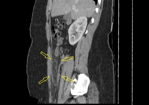 Sagittal abdominal CT scan (native series) showing intra-abdominal fat inflammation in the pericecal region (arrows).