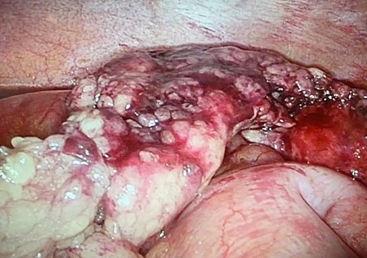 Intraoperative finding of partial infarction of the right side of the great omentum.