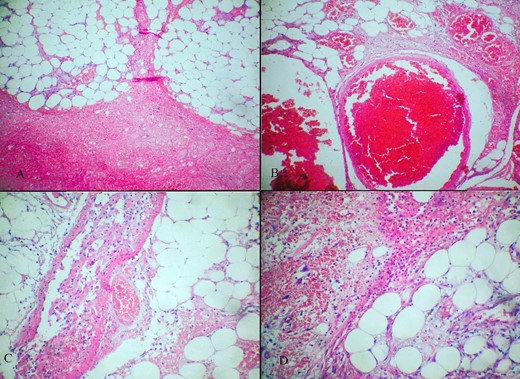 (A–D) Hematoxylin-eosin stain showing (A) adipose tissue with wide hemorrhage; (B) marked vascular congestion; (C) thrombosis in certain vessels; (D) bleeding, adipose necrosis and reactive inflammation.