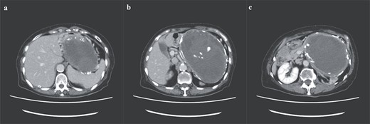 Preoperative abdominal enhanced CT showing a large hematoma-like cystic lesion in the pancreatic tail.