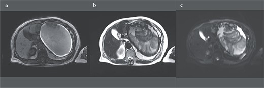 Preoperative abdominal enhanced MRI showing a 156 × 112 mm marginal T1W high (a) and an internal T2W uneven low signal (b); diffusion shows some high signal, but abnormal enhancement cannot be noted (c).