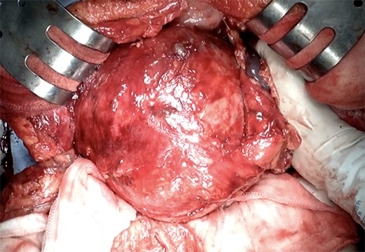 The intraoperative photograph of a giant pancreatic cystic lesion.