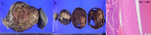 Macroscopic (a, b) and histopathological findings (c); (a) the excised specimen consisted of pancreatic parenchyma and a huge cystic mass measuring 16 × 17 × 13 cm; (b) the huge cystic mass was unilocular cyst without intraluminal protrusions and filled with hemorrhagic and thrombus-like contents; (c) hematoxylin–eosin staining, from left to right: pancreatic tissue, cyst wall (eosinophilic zone), cyst lumen; no obvious neoplastic lesions were detected within the pancreatic parenchyma; the cyst wall was composed of hyalinized fibrous tissue with marked calcification, but no intraductal epithelial lining or pancreatic parenchyma was observed; the continuity of cystic lumen and pancreatic parenchyma was not detected, therefore this long-standing hematoma like lesion was considered pancreatic pseudocyst.