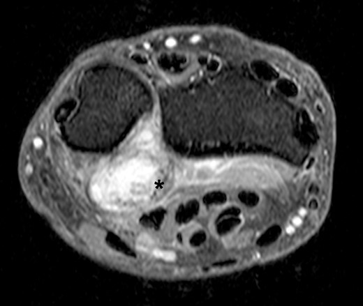 Axial slice of a fat suppressed PD Dixon—synovial capsular proliferation on the volar aspect of the DRUJ (asterix); the capsule is thickened, additionally evidence of hypointense internal structures aside the capsular proliferation.