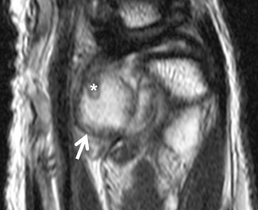 Sagittal slice of a T2-weighted fast-spin echo sequence of the DRUJ—well-defined hyperintense lesion on the volar aspect of the DRUJ; capsular blooming artifact (short arrow); hypointense, internal structure within the distended DRUJ (asterix), chondromatosis foci accordingly.