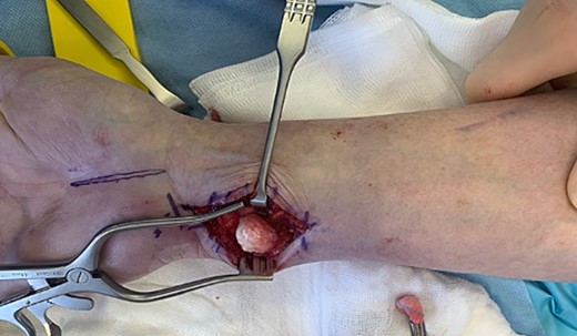 Intraoperative photograph of the exposed SC of the DRUJ—the tumor of 15 mm diameter is located volar to the DRUJ and next to the FCU tendon.