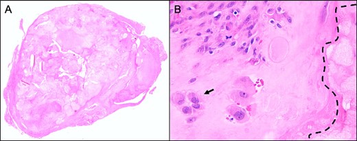 Representative histological slide of the lesion in low magnification (A; 2.5×) shows a relatively well-circumscribed multinodular tumor; higher magnification (B; 40×) demonstrates a cartilaginous nodule, composed of focally clustered chondrocytes (arrow) in a hyaline matrix with beginning calcification (dotted line); both hematoxylin & eosin staining.