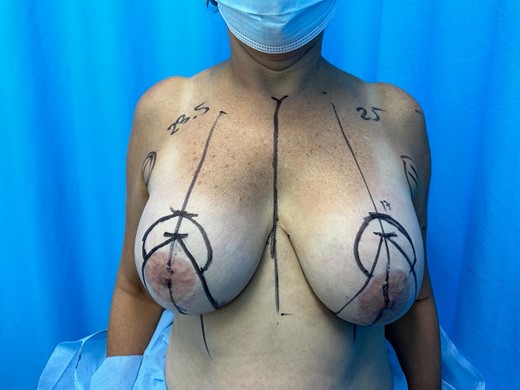 Preoperative marking detailing the distance of the right nipple areola complex: 23.5 cm left 25 cm and point A marked at 17 cm bilaterally under wise pattern.