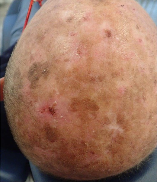 Clinical appearance of the lesion(s). The wound healing is challenging due to exposure to environmental factors (photodermatose) and potential complications arising from their location.