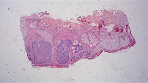 Histological results provide typically nesting patterns composed of proliferating basaloid cells. Basaloid cells arrange themselves in a palisading pattern at the periphery of the nests. This palisading is a key histological feature and is often linked to a picket fence appearance. The stroma surrounding the nests typically show variable degrees of fibrosis and inflammation. This fibrotic stroma may contain collagen fibers, and the inflammatory infiltrate may consist of lymphocytes and histiocytes (Dr.Jäkel, Pathologie Bremen, Bremen).