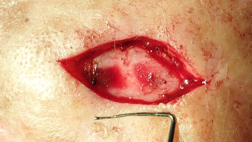 The excisional biopsy was undertaken to remove the entire lesion. The obtained tissue sample was then sent to the pathology laboratory for analysis. The defect is too large to enable primary wound closure.
