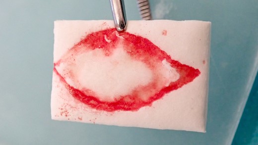 The excised area was marked on a resorbable collagen matrix (Mucograft®, Geistlich, Wolhusen) like an impression. This material was used to cover the defect and to avoid any donor site morbidity from creating flaps to close the defect.